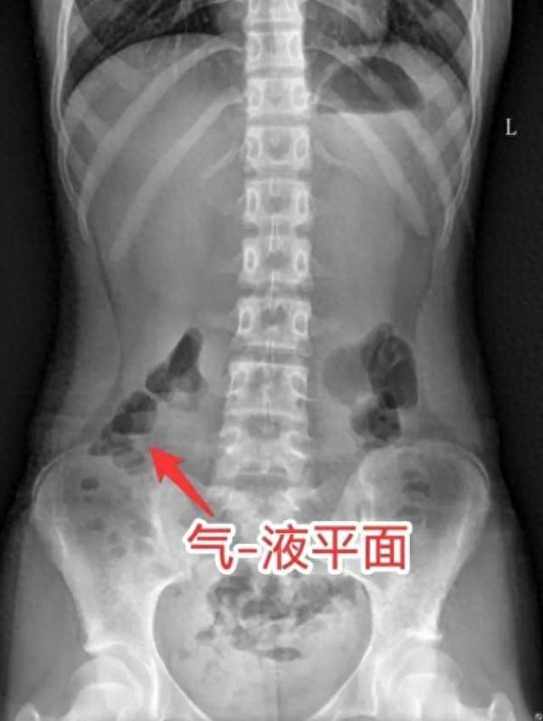 连吐10余次，12岁男孩被紧急送医！过年期间千万要注意