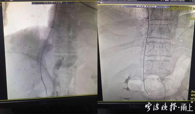 浙江男子饭后吃了一道点心，大口吐血1000毫升